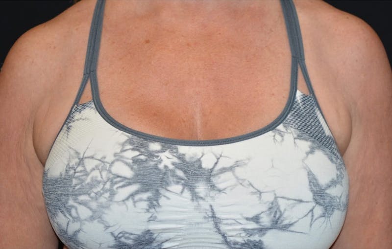 CoolSculpting Before & After Gallery - Patient 355911 - Image 1