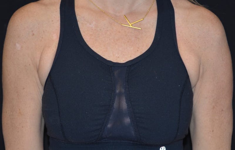 CoolSculpting Before & After Gallery - Patient 259967 - Image 2