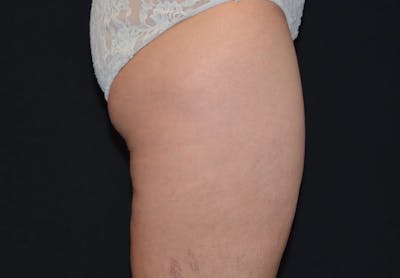 CoolSculpting Before & After Gallery - Patient 233340 - Image 2