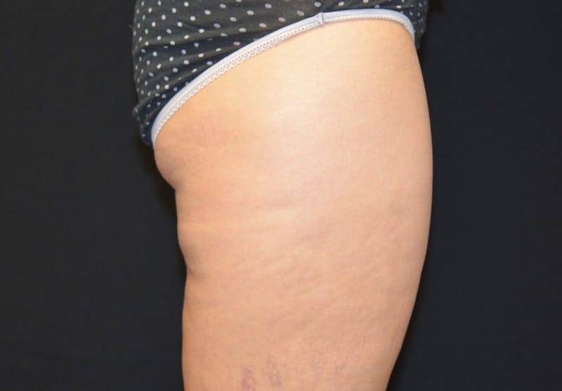CoolSculpting Before & After Gallery - Patient 233340 - Image 1