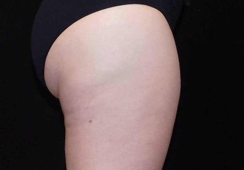 CoolSculpting Before & After Gallery - Patient 347840 - Image 2