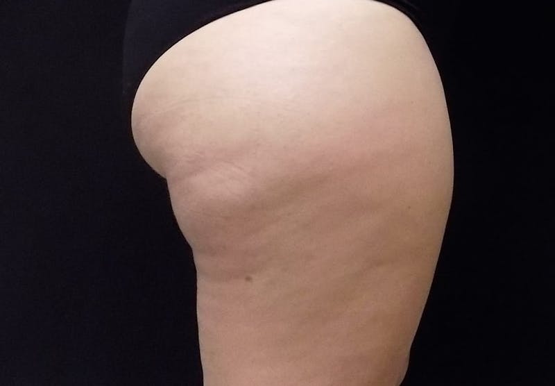 CoolSculpting Before & After Gallery - Patient 347840 - Image 1