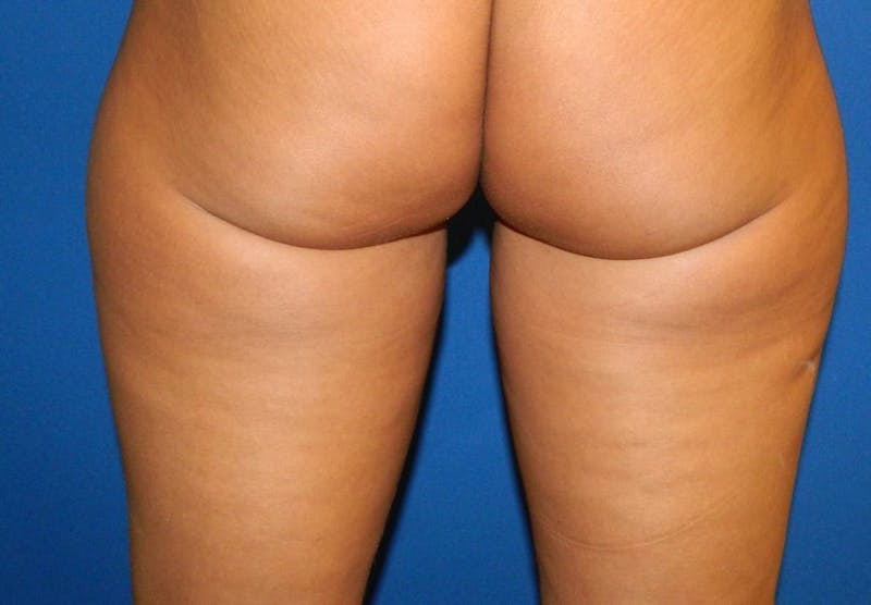 CoolSculpting Before & After Gallery - Patient 392302 - Image 1
