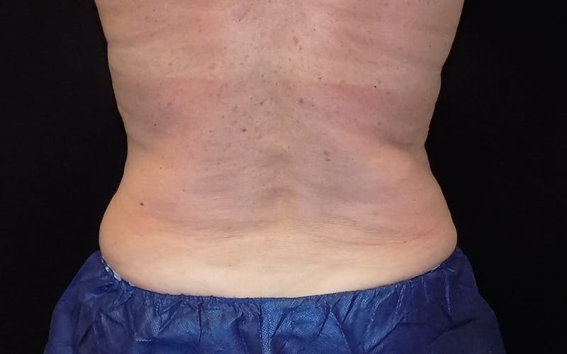 CoolSculpting Before & After Gallery - Patient 211857 - Image 2
