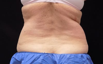 CoolSculpting Before & After Gallery - Patient 211857 - Image 1