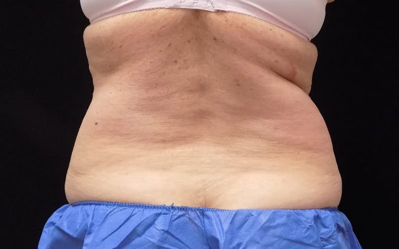 CoolSculpting Before & After Gallery - Patient 211857 - Image 1