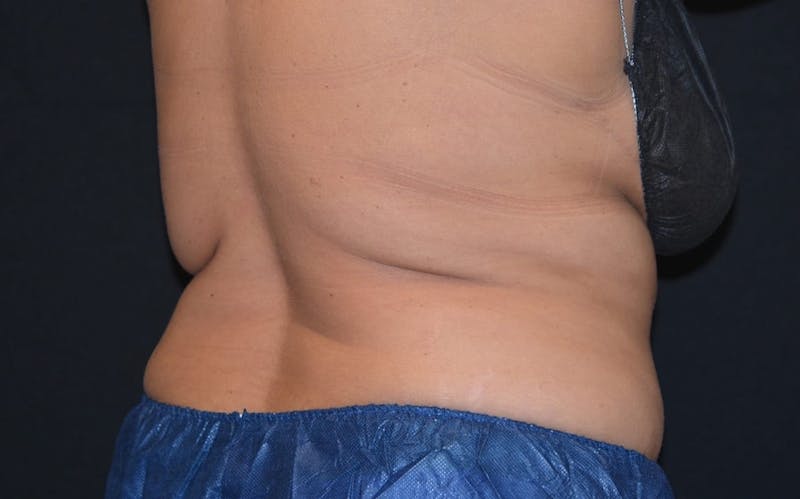 CoolSculpting Before & After Gallery - Patient 412507 - Image 2