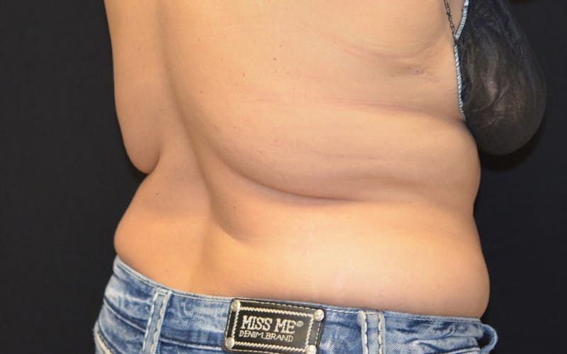 CoolSculpting Before & After Gallery - Patient 412507 - Image 1