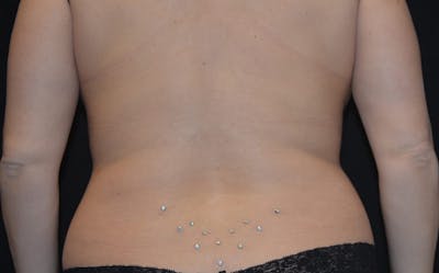 CoolSculpting Before & After Gallery - Patient 257934 - Image 2