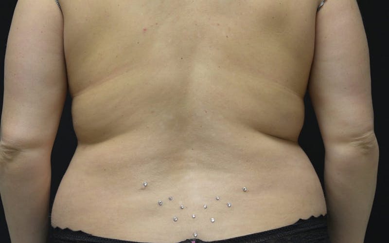 CoolSculpting Before & After Gallery - Patient 257934 - Image 1