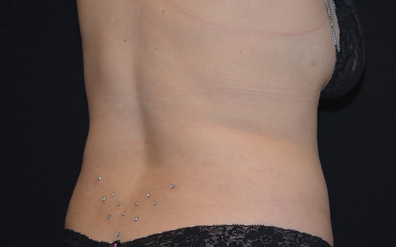 CoolSculpting Before & After Gallery - Patient 257934 - Image 4