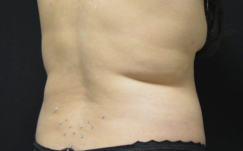 CoolSculpting Before & After Gallery - Patient 257934 - Image 3