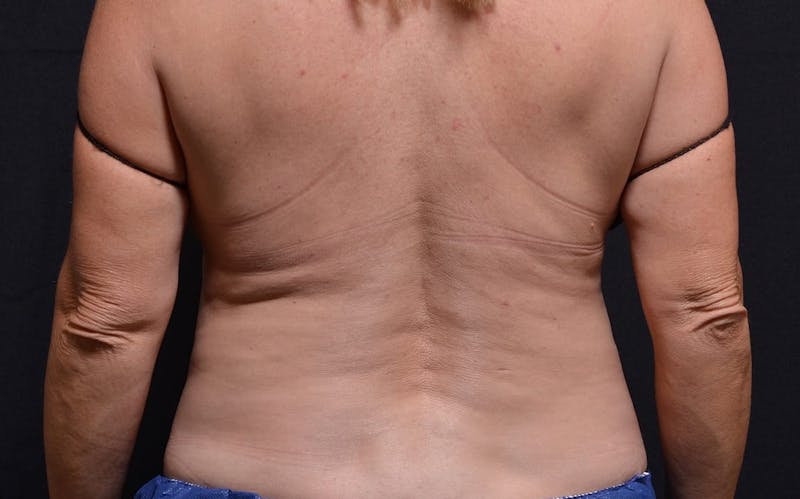 CoolSculpting Before & After Gallery - Patient 300925 - Image 2