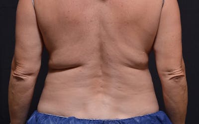 CoolSculpting Before & After Gallery - Patient 300925 - Image 1
