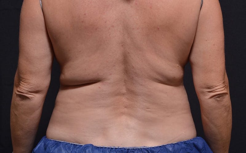 CoolSculpting Before & After Gallery - Patient 300925 - Image 1
