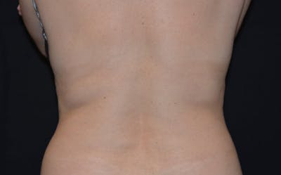 CoolSculpting Before & After Gallery - Patient 167248 - Image 2