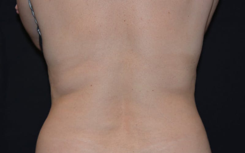 CoolSculpting Before & After Gallery - Patient 167248 - Image 2