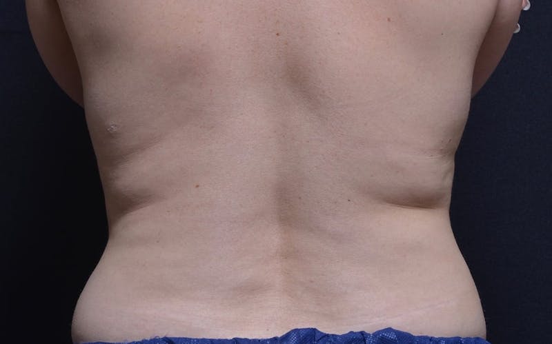CoolSculpting Before & After Gallery - Patient 167248 - Image 1