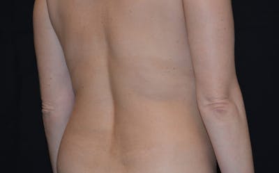CoolSculpting Before & After Gallery - Patient 663665 - Image 2