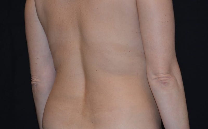 CoolSculpting Before & After Gallery - Patient 663665 - Image 2