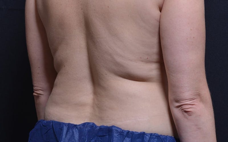 CoolSculpting Before & After Gallery - Patient 663665 - Image 1