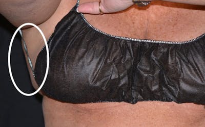 CoolSculpting Before & After Gallery - Patient 378226 - Image 2