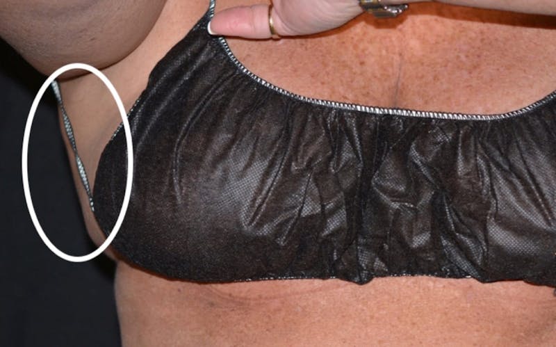 CoolSculpting Before & After Gallery - Patient 378226 - Image 2