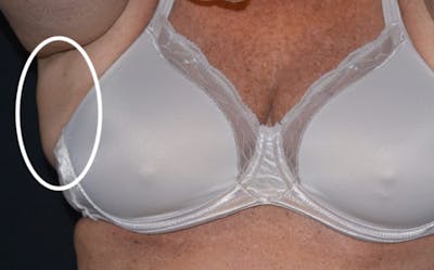 CoolSculpting Before & After Gallery - Patient 378226 - Image 1