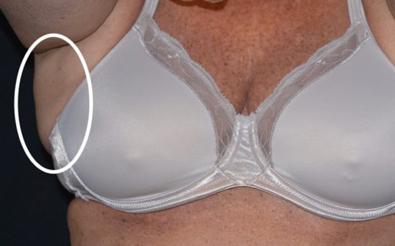 CoolSculpting Before & After Gallery - Patient 378226 - Image 1