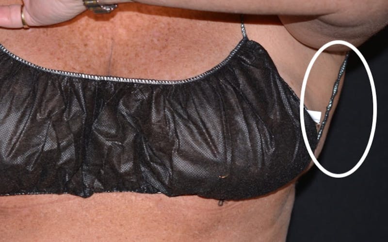 CoolSculpting Before & After Gallery - Patient 378226 - Image 4