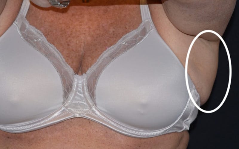 CoolSculpting Before & After Gallery - Patient 378226 - Image 3