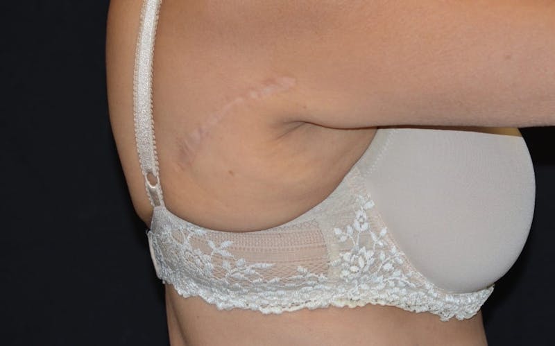 CoolSculpting Before & After Gallery - Patient 226934 - Image 2
