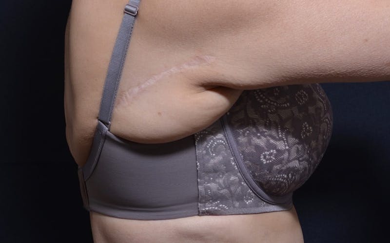 CoolSculpting Before & After Gallery - Patient 226934 - Image 1