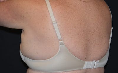CoolSculpting Before & After Gallery - Patient 346893 - Image 2