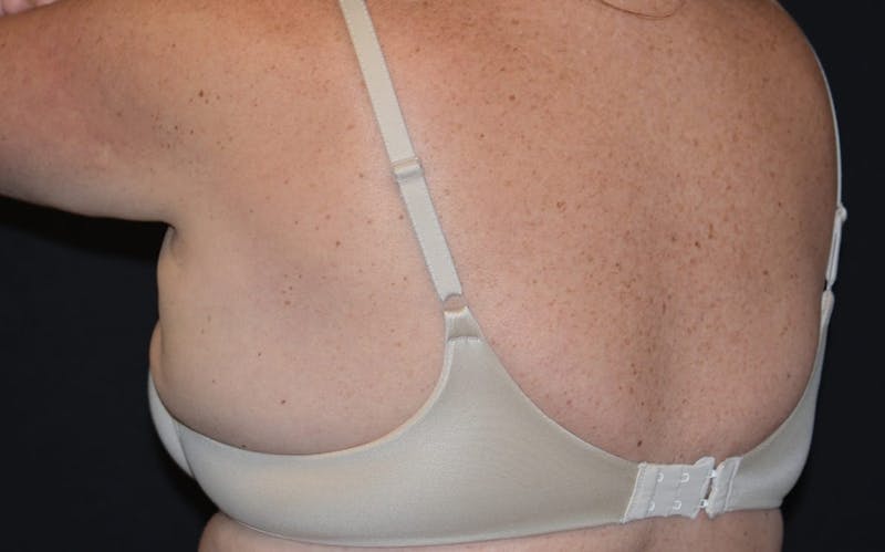 CoolSculpting Before & After Gallery - Patient 211857 - Image 4
