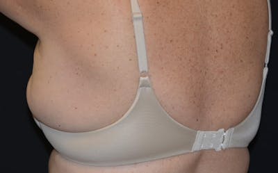 CoolSculpting Before & After Gallery - Patient 346893 - Image 1
