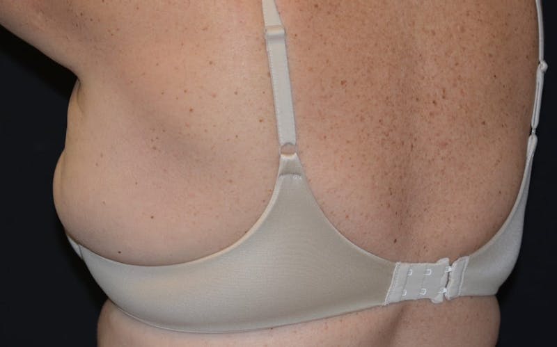CoolSculpting Before & After Gallery - Patient 211857 - Image 3