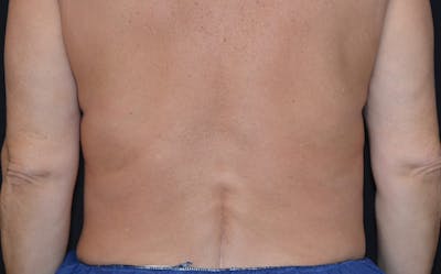 CoolSculpting Before & After Gallery - Patient 415332 - Image 2