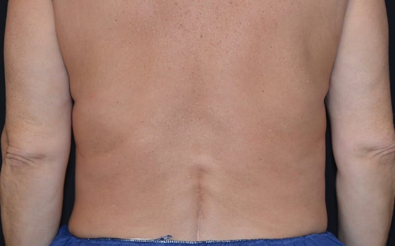CoolSculpting Before & After Gallery - Patient 415332 - Image 2