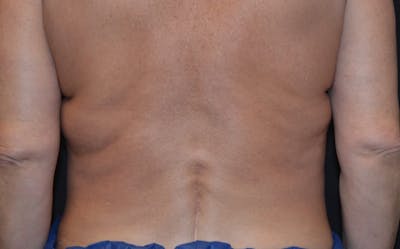 CoolSculpting Before & After Gallery - Patient 415332 - Image 1