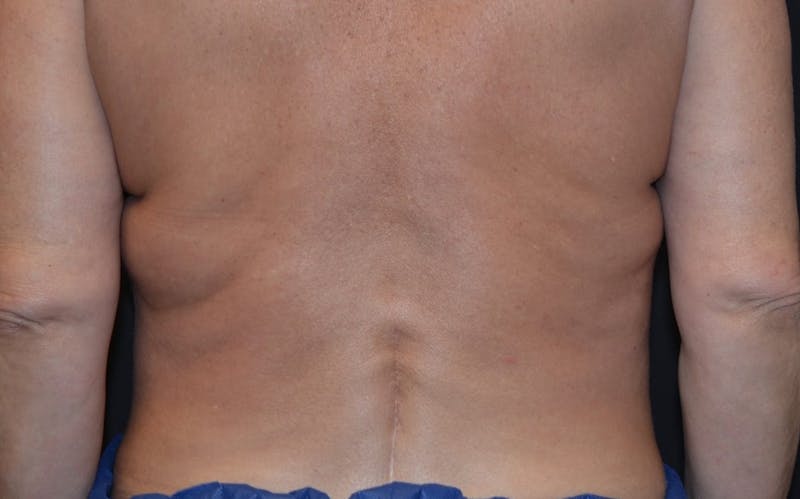 CoolSculpting Before & After Gallery - Patient 415332 - Image 1