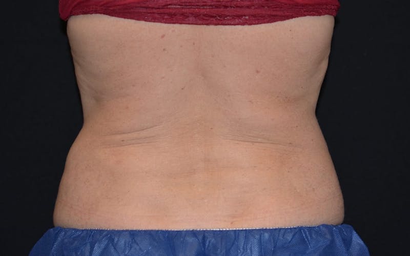 CoolSculpting Before & After Gallery - Patient 364006 - Image 2