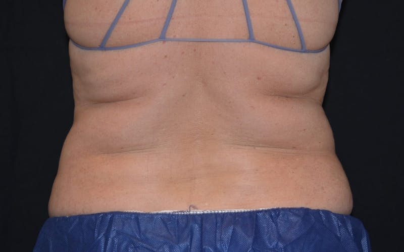 CoolSculpting Before & After Gallery - Patient 364006 - Image 1