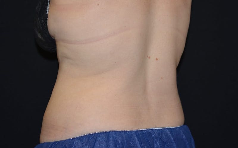 CoolSculpting Before & After Gallery - Patient 316470 - Image 2