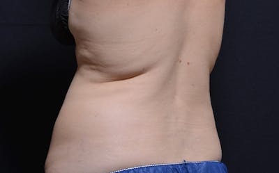 CoolSculpting Before & After Gallery - Patient 316470 - Image 1