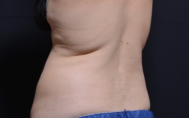 CoolSculpting Before & After Gallery - Patient 316470 - Image 1