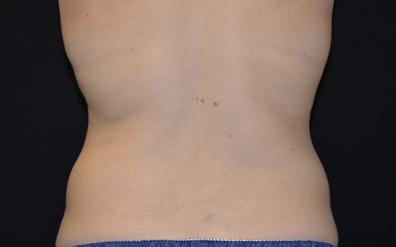 CoolSculpting Before & After Gallery - Patient 212927 - Image 2