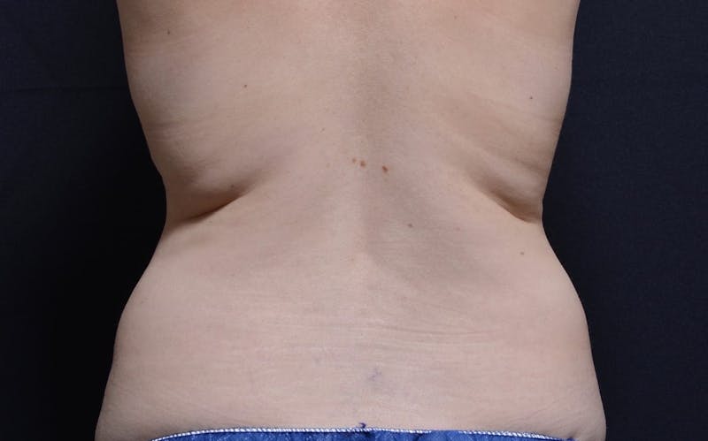 CoolSculpting Before & After Gallery - Patient 212927 - Image 1