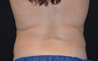 CoolSculpting Before & After Gallery - Patient 231639 - Image 2
