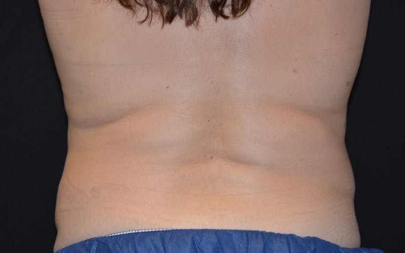 CoolSculpting Before & After Gallery - Patient 231639 - Image 2